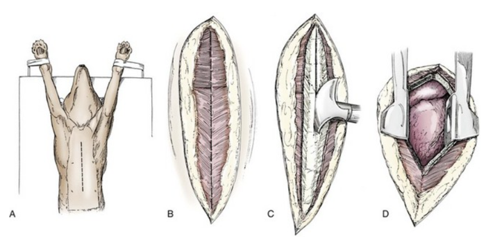 흉골절제술 수술 방법을 묘사한 이미지