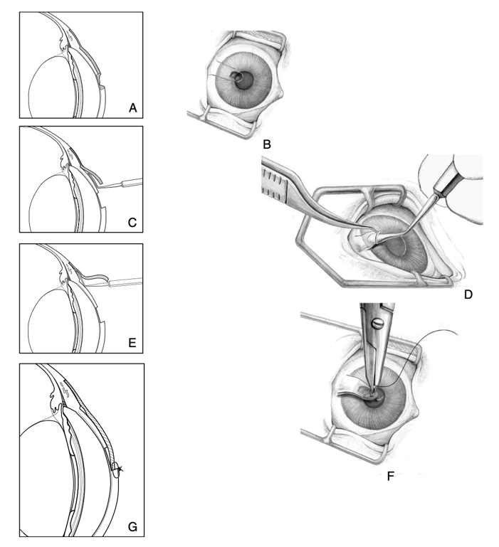 강아지 각결막 전위술 수술 방법을 묘사하는 이미지