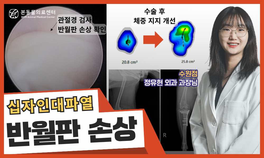 전십자인대 파열과 병발한 반월판 손상 치료 케이스