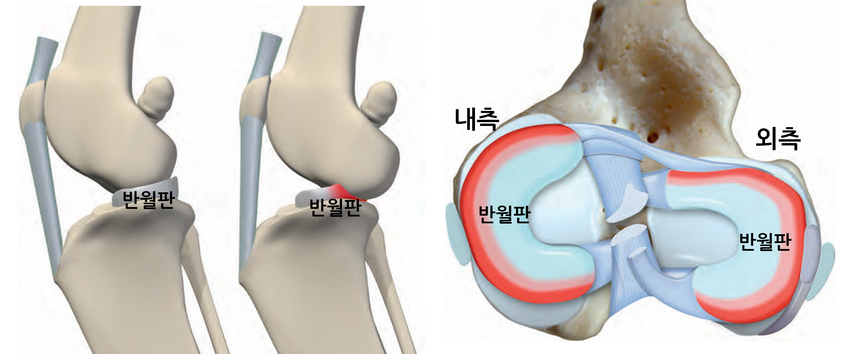 강아지의 반월판 구조와 반월판 손상에 대한 설명